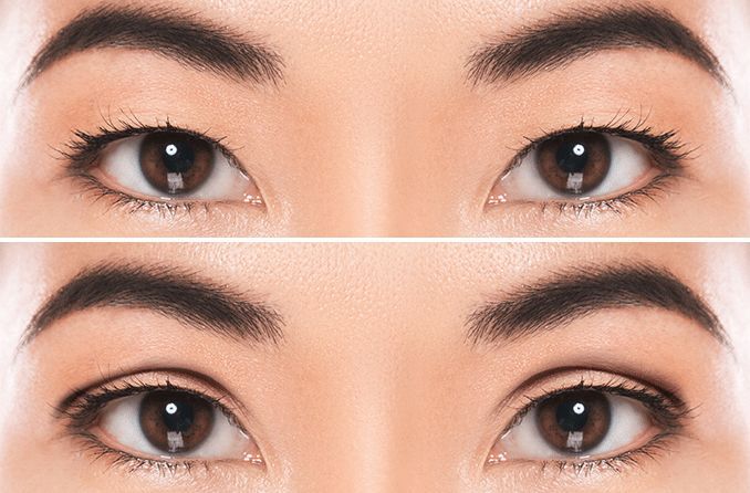 is-double-eyelid-surgery-good-or-bad-neo-media-lab