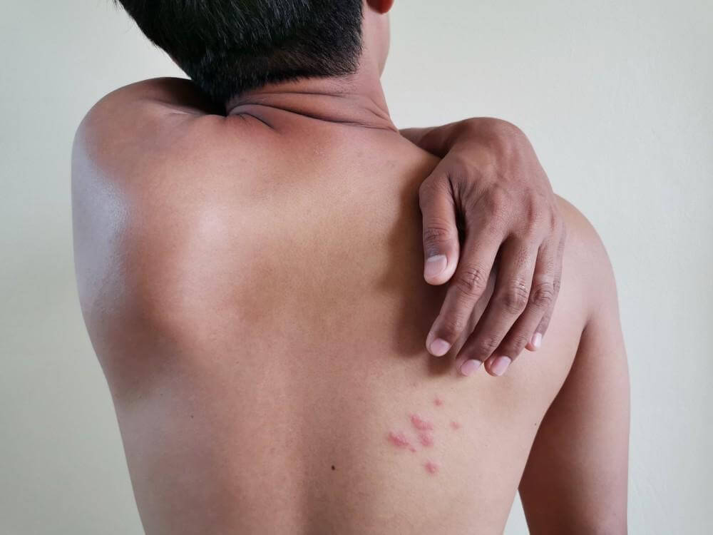 Managing Shingles Pain: What to Expect and How to Treat