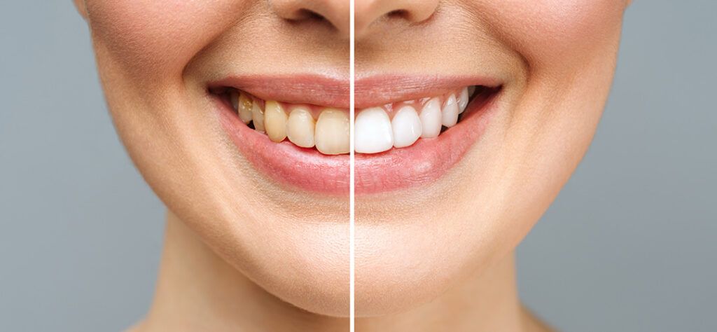 Keeping Your Teeth White After A Cosmetic Procedure 