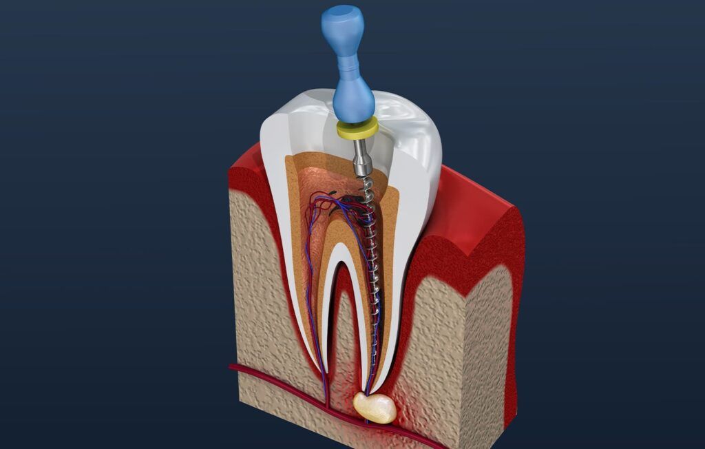 Benefits Of Root Canal Treatment: Oral Rehabilitation Chronicles