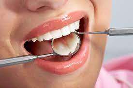 Composite Fillings: An Aesthetic Combination Of Luxury And Durability