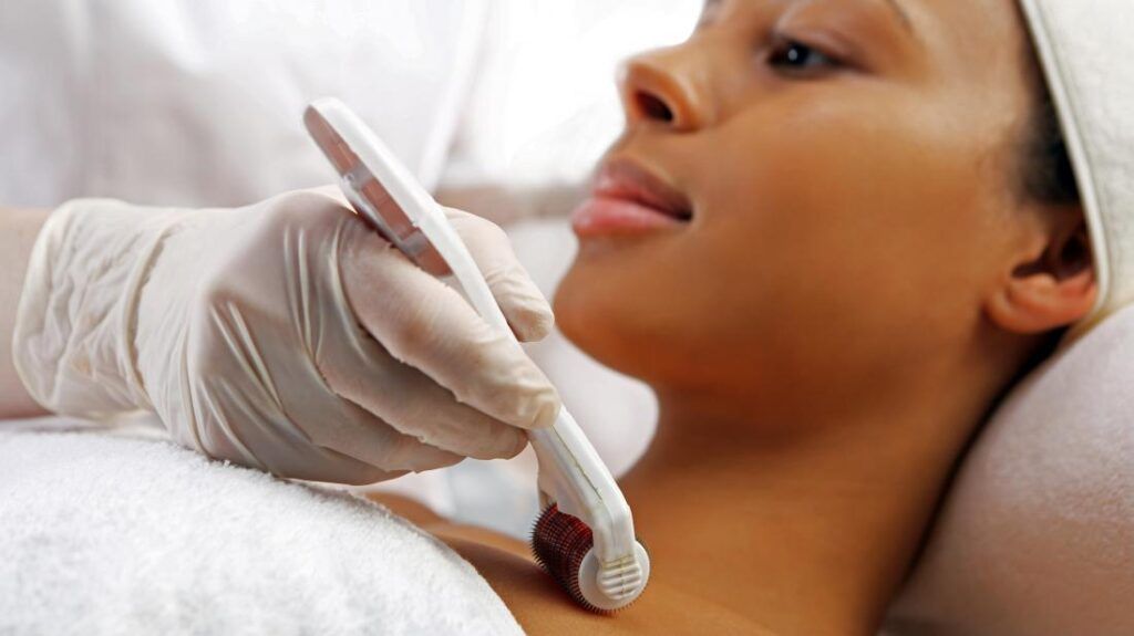 microneedling with PRP-RX