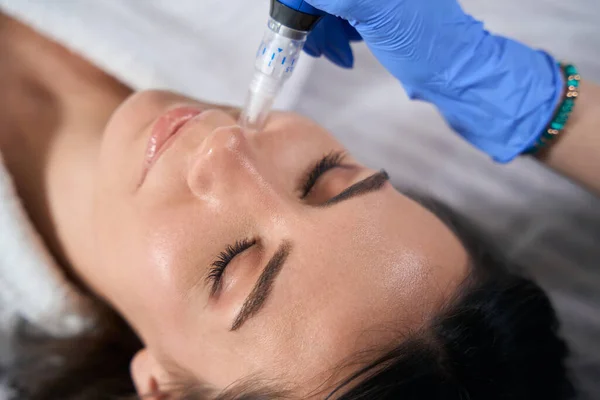 microneedling with PRP-RX